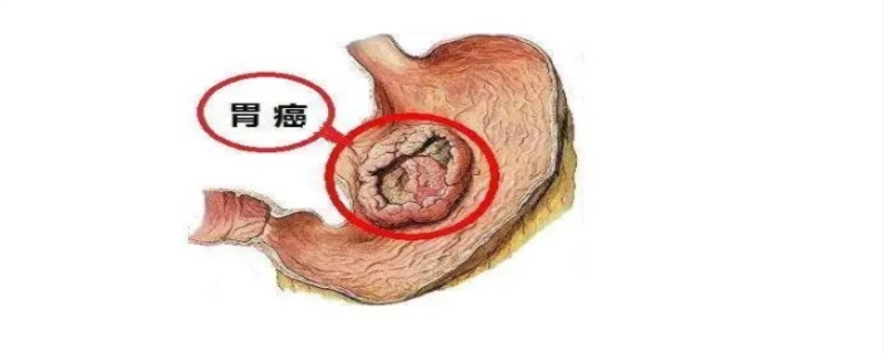 胃癌晚期症状